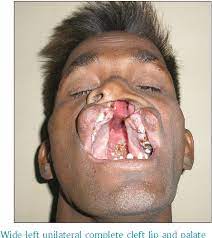 Pdf Ectrodactyly Ectodermal Dysplasia Cleft Lip Palate Syndrome A Rare Entity Semantic Scholar