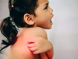 Authors givler dn, basit h, givler a. Pityriasis Alba Causes Symptoms And Treatments