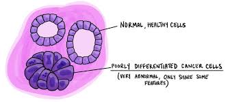 Certain inherited genetic defects (for example. Poorly Differentiated Pathology Dictionary Mypathologyreport Ca