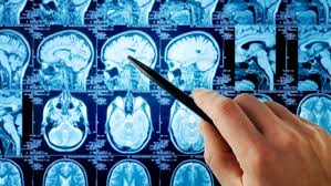 Headaches, which may be severe and may worsen with activity or in the early morning. What Causes Brain Tumors Brain Tumor Treatment Prognosis And More