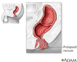 Image result for Rectal Prolapse