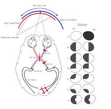 Image result for Visual Field Deficit