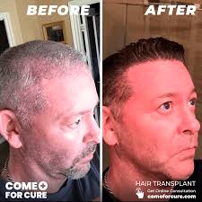 Hair Transplant Reviews