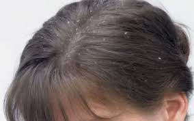 Check spelling or type a new query. Elak Kelemumur Kepala Dengan 5 Makanan Ini Masalah Rambut