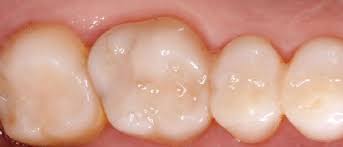 Composite Dental Fillings Cost In India Is Among The Most Popular Cosmetic Dentistry Dealings That Are Being Used These Days In Order To Promote Tooth Restorati