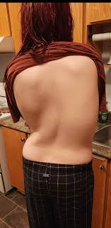 ما هي أبرز أسباب اعوجاج العمود الفقري عند النساء؟