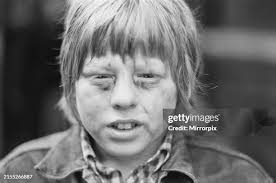 1,076 The Bruised Boy Stock Photos, High-Res Pictures, and Images