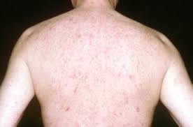 Image result for skin rash acute hiv infection