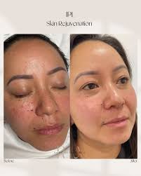 I know there's a lot of new terminology you hear once you start routinely  getting facials. Here's a quick little breakdown 😉 #remiaesthetics  #skinjourney #understandingskin #skincareroutine #skingamechanger #skincare  #venusai #venusviva #venusversa ...