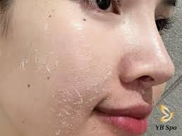 Nên Lăn Kim Hay Peel Da? Cái Nào Tốt Hơn? Lưu ý Cần Biết