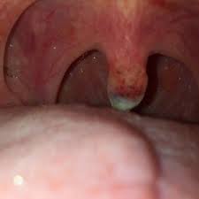 Infections can lead to a swollen uvula, including the flu, mononucleosis, croup, and strep throat. Infected Uvula Post Surgery Photo