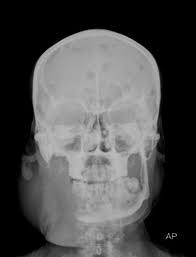 A pictorial review of diagnostic and. Multiple Myeloma With Mandibular Mass As Predominant Presentation Radiology Case Radiopaedia Org