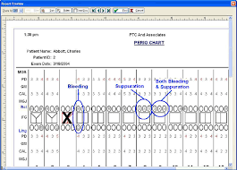 Show Bleeding And Or Suppuration When Printing Perio