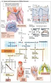 O mitral valve most commonly involved valve. 19 Mitral Stenosis Ideas Mitral Valve Stenosis Valve