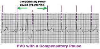 During a premature ventricular contraction (pvc), the heartbeat is initiated by the purkinje fibers rather than the sa node. Ekg Strip Search Premature Ventricular Contraction Pvc