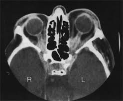 Inflammatory Orbital Pseudotumors Ento Key