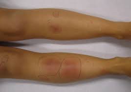 It's most common in teens and young adults. News Mononucleosi Infettiva Novita 2021 Mondomedicina It