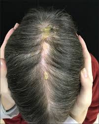 The scales are arranged in an overlapping manner like tiles on a roof or flakes of asbestos, hence the name. Trigeminal Trophic Syndrome Simulating Pityriasis Amiantacea Abstract Europe Pmc