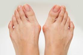 Ein hallux valgus kann sehr schmerzhaft sein. Fuss Operationen In Graz Orthopade Doz Dr Gruber