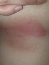 Image result for heat rash under breasts