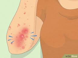 Image result for scabies symptoms