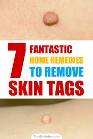 7 Fantastic Home Remedies To Remove Skin Tags Skin Tag Removal Skin Tags Apple Cider Vinegar Skin Tag