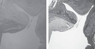 Bilateral Radial Artery Aneurysms In The Anatomical Snuff Box Seen In Marfan Syndrome Patient Case Report And Literature Review Abstract Europe Pmc Flexor carpi ulnaris tendon, ulnar n, ulnar a, palmaris longus tendon. europe pmc