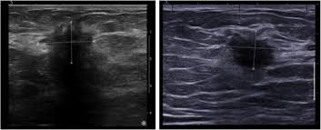 The type of tissue where your breast cancer arises determines how the cancer behaves and what treatments are most effective. Are Baseline Ultrasound And Mammographic Features Associated With Rates Of Pathological Completes Response In Patients Receiving Neoadjuvant Chemotherapy For Breast Cancer Cancer Imaging Full Text