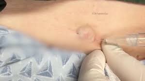 Cvs.com® is not available to customers or patients who are located outside of the united states or u.s. Is This The Worst Blackhead Video Yet Daily Mail Online