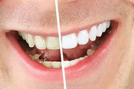 Is Professional Teeth Whitening Worth The Cost Dentist In Madison Wi