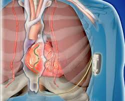 Jun 17, 2021 · eriksen selbst habe dieser behandlung bereits zugestimmt, teilte der dänische verband mit. New Technology And Market Challenges Facing Implantable Cardioverter Defibrillators Daic