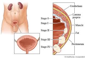 Image result for Bladder Cancer Staging
