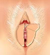 Auch wenn die inneren schamlippen deutlich sichtbar sind und womöglich herausschauen, werden deine schönsten lippen von männern weder als. Schamlippenverkleinerung Der Inneren Schamlippen Labioplastik In Berlin
