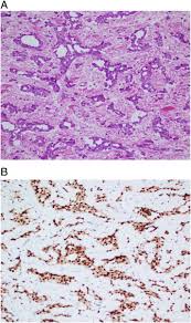 A clinicopathologic study of 26 cases. Well Differentiated Papillary Mesothelioma A 17 Year Single Institution Experience With A Series Of 75 Cases Sciencedirect