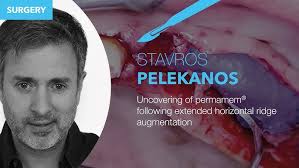 Uncovering of permamem® following extended horizontal ridge augmentation