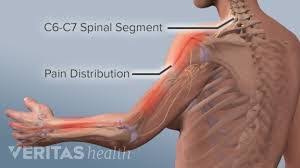 Nerves in your spine and other parts of your body can be. What Does The Pain Of A Pinched Nerve Feel Like Quora