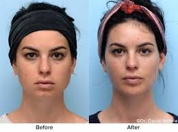 Jawline Contouring With Filler in San Francisco