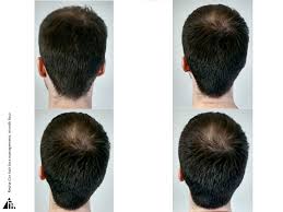 Based on many herbal extracts; Hair Loss Management Revita Cor Trial 4 The Ting Thing