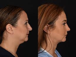 Plastic Surgery Patients From Lafayette, LA