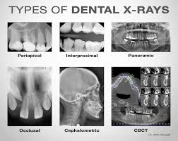 Maybe you would like to learn more about one of these? Rohaya Dental Surgery Radiografi Pergigian Dental Radiography Radiograf Atau Juga Dikenali Sebagai X Ray Adalah Salah Satu Keperluan Dalam Rawatan Pergigian X Ray Dibahagikan Kepada Dua Kategori Utama Radiograf Dalam Mulut Intraoral Dan Radiograf