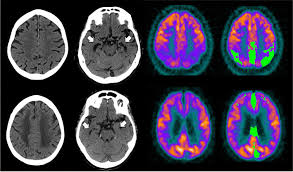 Mri or magnetic resonance imaging uses strong magnetic fields and. Typical Examples Of Alzheimer Disease Ad Top And Vascular Dementia Download Scientific Diagram