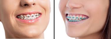 Terbaru, pengarah kanan (kesihatan pergigian) kementerian kesihatan malaysia dr. 2 Tahun Tunggu Akhirnya Dah Cabut Braces Farah Dafri