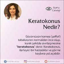 Keratokonus Nedir Gozumuzun Kornea Seffaf Tabakasinin Normalden Ince Olup Konik Sekilde Sivrilesmesine Keratokonus Denir Keratokonus Korn Bilgi Sekil