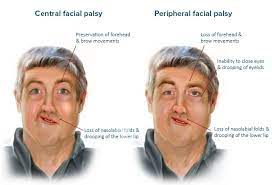 We did not find results for: Bell Palsy A Clinical Diagnosis With A Management Challenge