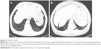 Rbild, dip and plch are specific ilds that have a strong causal association with cigarette smoking.18,19 smoking is likely to induce an immune response in certain individuals. Overlaps And Uncertainties Of Smoking Related Idiopathic Interstitial Copd