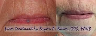 Oral nevi are usually slightly raised. Blood Blister On Lip That Won T Go Away Treatment Here Bauer Smiles