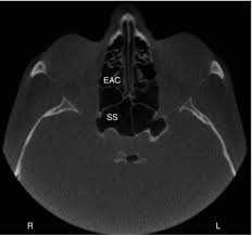 3 Paranasal Sinuses And Mastoid Air Cells Pocket Dentistry