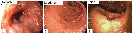Image result for Intestinal Enteropathy