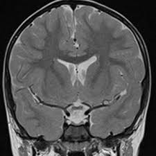 Pdf Pituitary Stalk Interruption Syndrome Case Report With Isolated Growth Hormone Deficiency