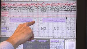 Natural Treatment For Cataplexy Sleep Study Results Chart